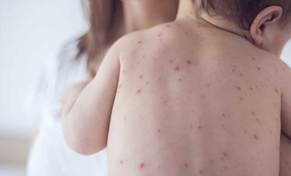 “1 yaş altı bebekler ağır kızamık için risk altında!”Alerjisi olanlara kızamık aşısı nasıl yapılmalı? 